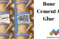 Bone Cement & Glue Market